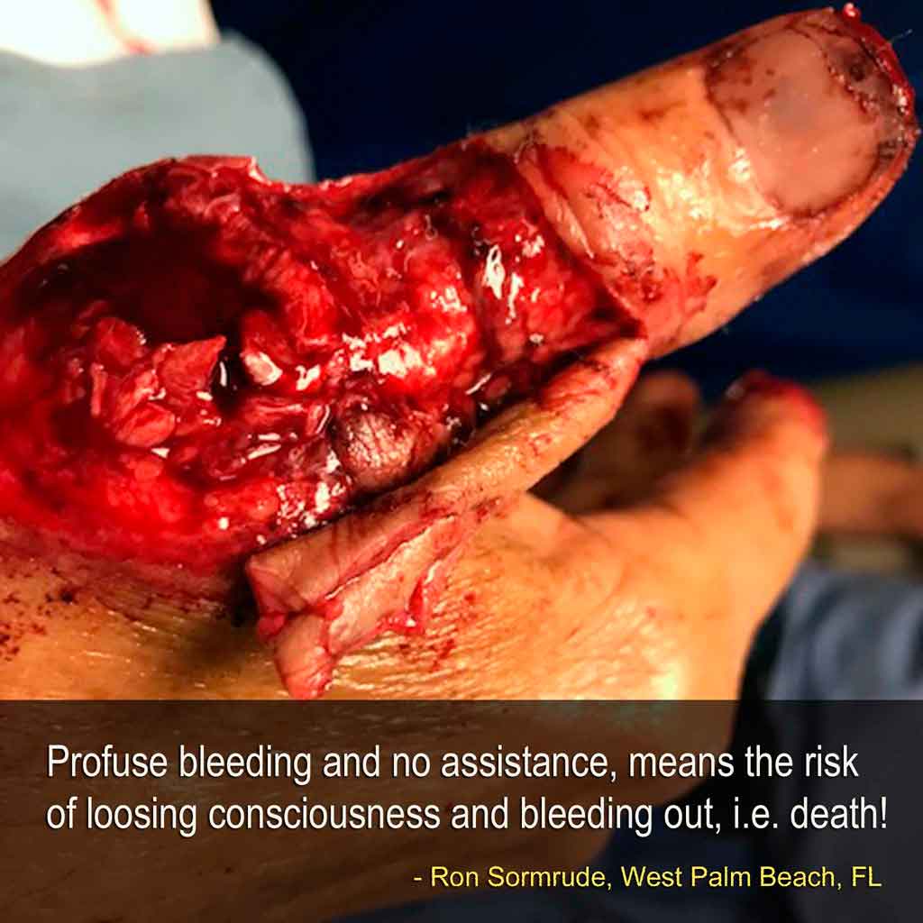 image of the damage to Ron's hand from the prop strike