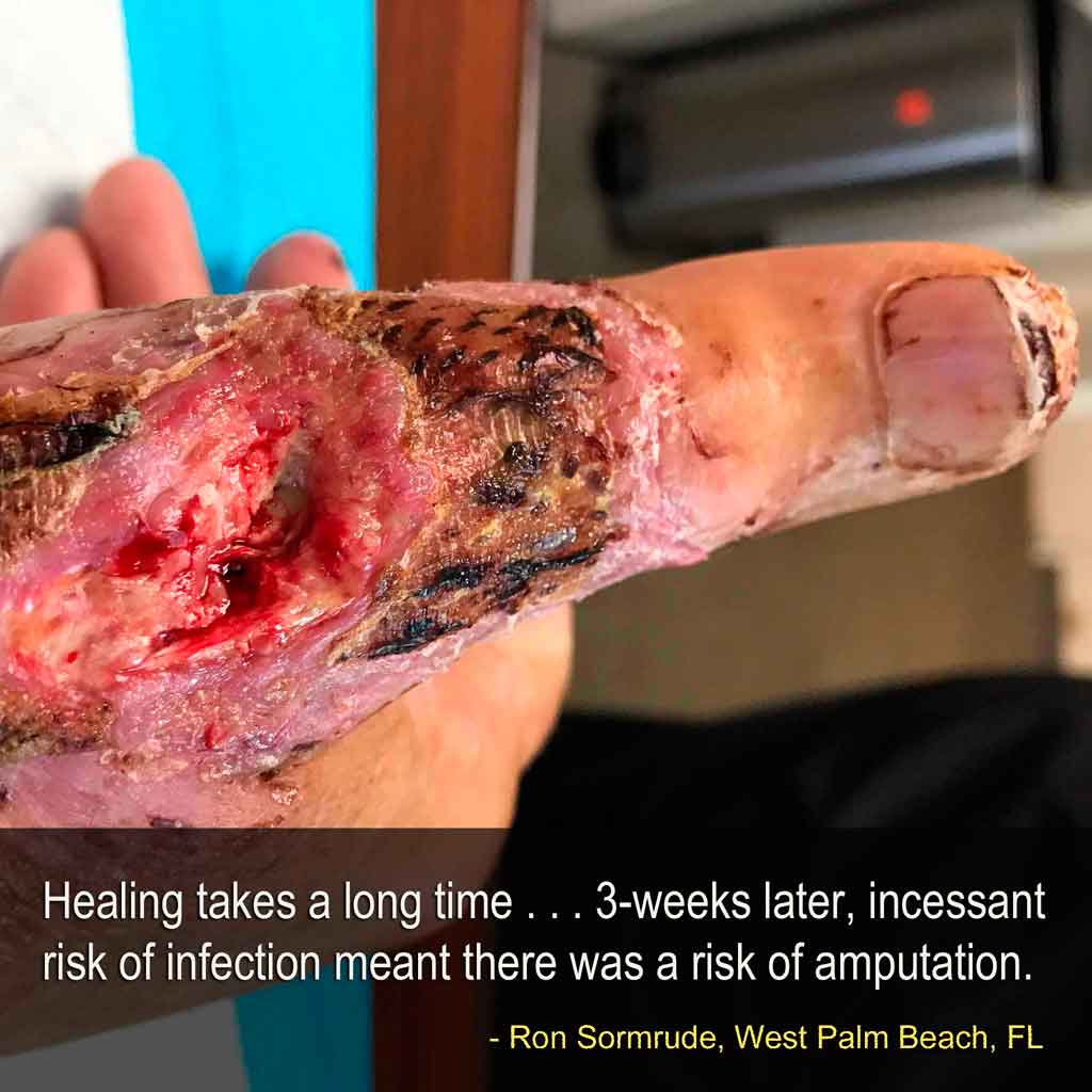 injured hand 3 weeks later