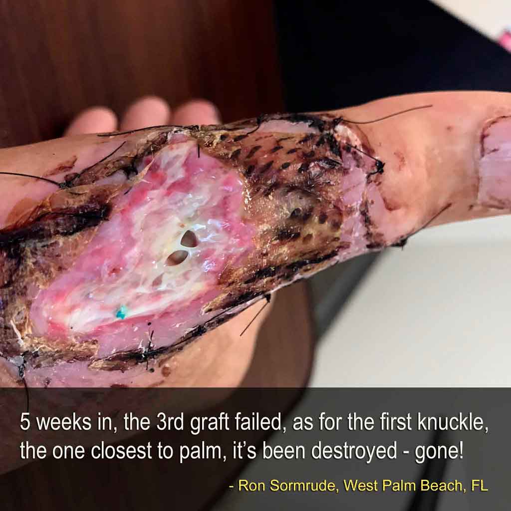 injured hand after 5 weeks and 3 grafts