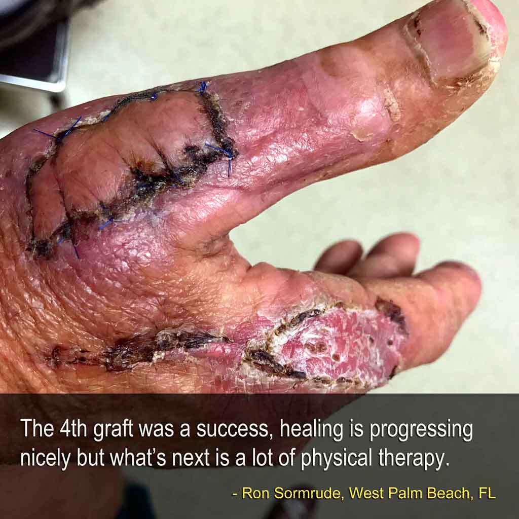 injured after 4th graft which was successful