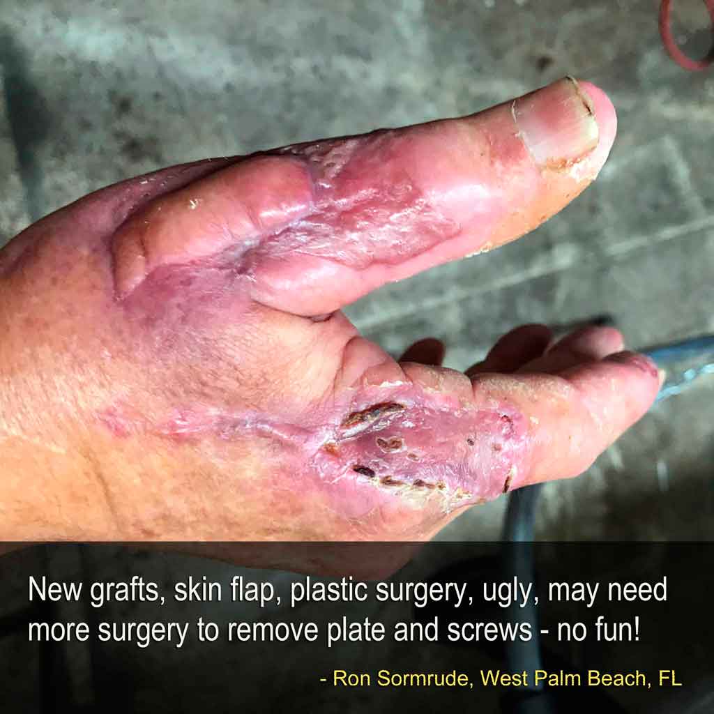 injured hand after skin grafts and plastic surgery