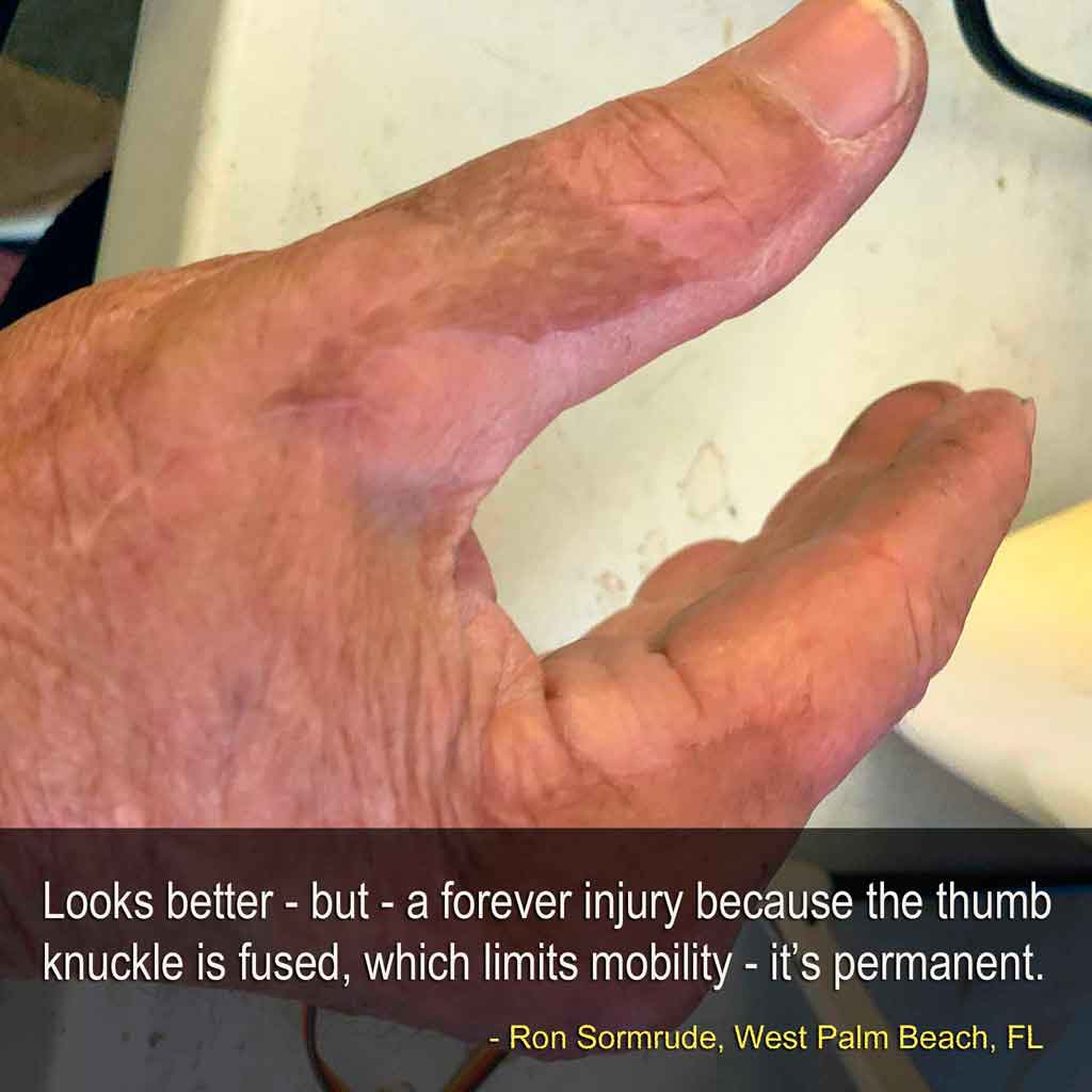 healing almost complete, but permanent loss of use to the lower joint of the thumb